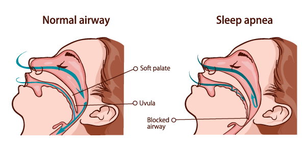 sleep apnea diagnosis
